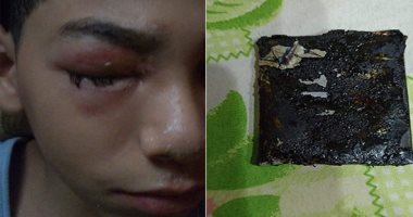 Photo of انفجار هاتف محمول في وجه “طفل” خلال تشغيله لعبة شهيرة في القاهرة