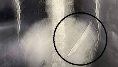 Photo of ابتلع سكينا طوله 27 سنتيمترا.. والأطباء يصنعون معجزة
