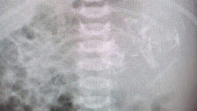 Photo of حالة طبية نادرة أذهلت الأطباء.. ولادة طفلة وبداخل بطنها جنين!