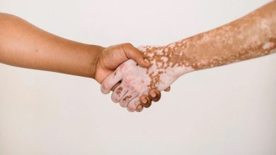 Photo of أول علاج موضعي لمرض البهاق