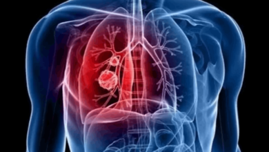 Photo of “قاتل خفي” يسبب سرطانات الرئة لغير المدخنين.. دراسة تكشف